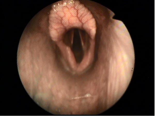 Endoscopic Picture of Horse Larynx